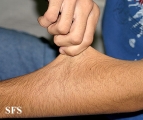 ehlers-danlos syndrome