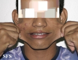 ehlers-danlos syndrome