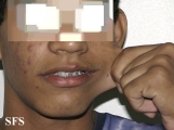ehlers-danlos syndrome