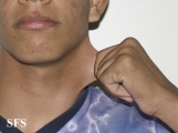 ehlers-danlos syndrome