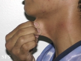 ehlers-danlos syndrome