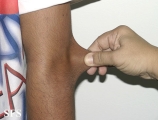 ehlers-danlos syndrome