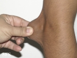 ehlers-danlos syndrome