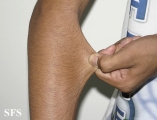 ehlers-danlos syndrome