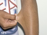 ehlers-danlos syndrome