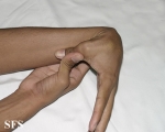 ehlers-danlos syndrome