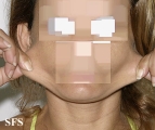 ehlers-danlos syndrome