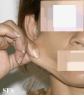 ehlers-danlos syndrome