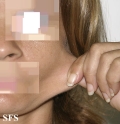 ehlers-danlos syndrome