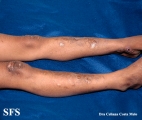 ehlers-danlos syndrome
