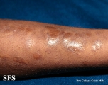 ehlers-danlos syndrome