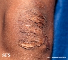 ehlers-danlos syndrome