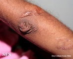 ehlers-danlos syndrome