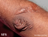 ehlers-danlos syndrome