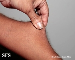 ehlers-danlos syndrome