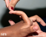ehlers-danlos syndrome