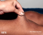 ehlers-danlos syndrome