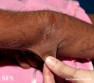 ehlers-danlos syndrome