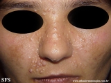 trichoepithelioma