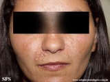 trichoepithelioma