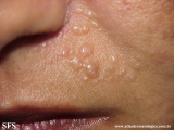 trichoepithelioma
