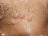 trichoepithelioma