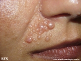 trichoepithelioma