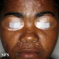trichoepithelioma