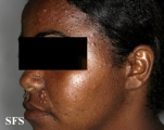 trichoepithelioma