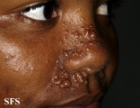 trichoepithelioma