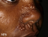 trichoepithelioma