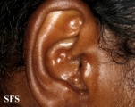 trichoepithelioma
