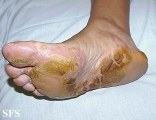 tylotic dermatitis