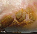 tylotic dermatitis