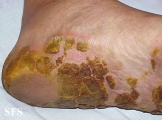 tylotic dermatitis
