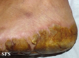 tylotic dermatitis