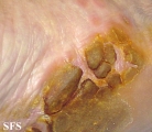 tylotic dermatitis
