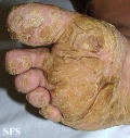 tylotic dermatitis