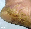 tylotic dermatitis