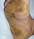 tylotic dermatitis
