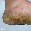tylotic dermatitis