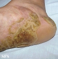 tylotic dermatitis