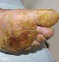tylotic dermatitis