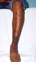 angiokeratoma circumscriptum