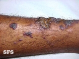angiokeratoma circumscriptum