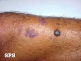 angiokeratoma circumscriptum