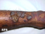 angiokeratoma circumscriptum