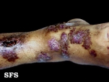 angiokeratoma circumscriptum