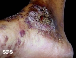 angiokeratoma circumscriptum