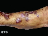 angiokeratoma circumscriptum